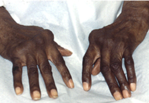 RA nodule