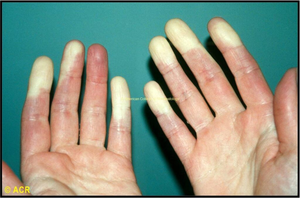 Raynaud's Phenomenon: Hands