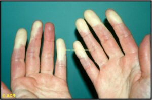 Raynaud's Phenomenon: Hands