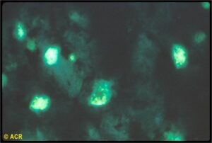 The speckled pattern of nuclear fluorescence has fine speckles in the nucleus. This pattern is found in the sera of patients with rheumatoid arthritis, systemic lupus erythematosus, mixed connective tissue disease, chronic discoid lupus, chronic lung disease, systemic sclerosis, and in a small number of normal elderly individuals.